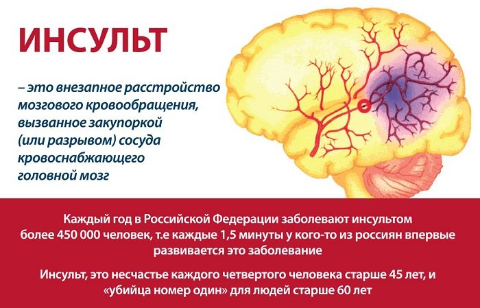 Стволовой инсульт прогноз. Поражение сосудов головного мозга. Сосудистые заболевания мозга инсульт.